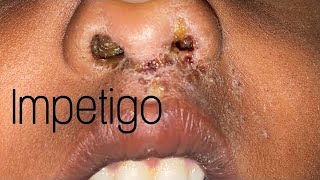 IMPETIGO  CAUSE SYMPTOMS AND TREATMENT [upl. by Nelli]