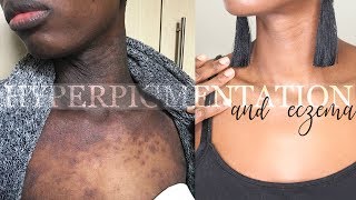 HEALING ECZEMA AND HYPERPIGMENTATION QampA WITH BEFORE AND AFTER [upl. by Anbul623]