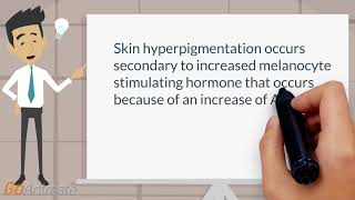 Hyperpigmentation of Addisons disease [upl. by Allisan]