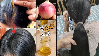 Regrowth Receding Hair line Hair  گنج پن ختم [upl. by Ennasirk873]