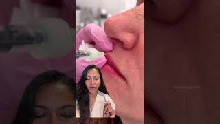 Botox Lip Flip  Lip Augmentation with Botox  shorts [upl. by Durwin989]