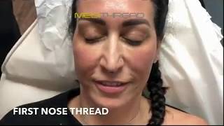 PDOTHREAD LIFT PROCEDURE BY MEDiTHREAD  Nose Lift [upl. by Duester]