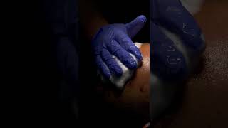 Sade Clinic  First hair wash after hair transplant hairtransplant fuehairtransplant hairloss [upl. by Lihkin]