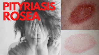 PITYRIASIS ROSEA  Answers of the common questions about Pityriasis Rosea What is Pityriasis rosea [upl. by Hammad]