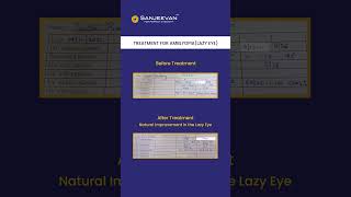 Treatment for Amblyopia Lazy Eye At Sanjeevan for perfect eyesight Mumbai [upl. by Schoenfelder]