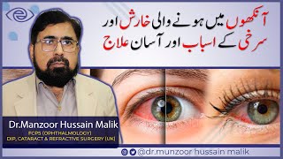 Eye Allergy Remedies  Tips for Itchy and Watery Eyes  UrduHindi [upl. by Leivad]