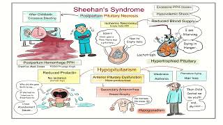 hypopituitary  sheehan syndrome [upl. by Kari]