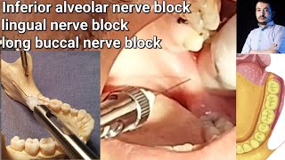 Local Anesthesia Inferior Alveolar Nerve block amp long buccal Nerves block Mandibular nerve block [upl. by Tatiania]