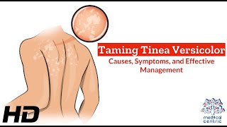 Tinea Versicolor Unveiled Causes Symptoms and Solutions [upl. by Lasonde]