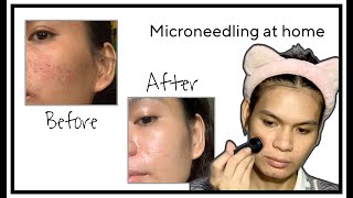 Microneeding at home before and after  How to treat acne scars  12th Microneedling Derma Stamp [upl. by Yrogreg]