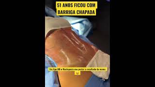 51 ANOS COM A BARRIGA CHAPADA  CIRURGIA PLÁSTICA [upl. by Santos]