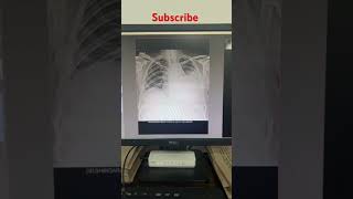 xray chest x ray PA view digital x ray machine radiology chest x ray kaise karte hai chest x ray [upl. by Roth]