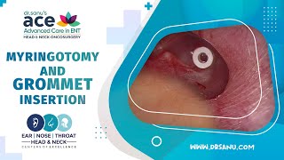 Bilateral Myringotomy and Ventilation Tube Grommet Insertion [upl. by Ashti]