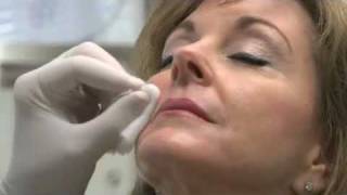 Radiesse in Nasolabial Folds  deNovo Medical Group  Dallas [upl. by Annav674]