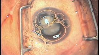 Anterior capsular dyes  ICG VS Trypan blue [upl. by Ycniuq588]