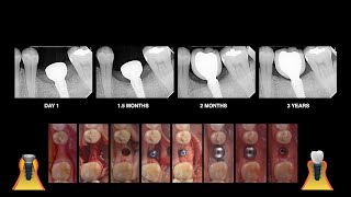 MARGINAL BONE GROWTH AND NO LOSS [upl. by Forrest]