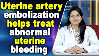 Uterine artery embolization helps treat abnormal uterine bleeding [upl. by Elicul]