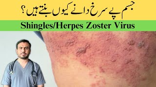 ShinglesHerpes Zoster Virus in UrduHindi [upl. by Yendahc]