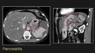 Abdominal Radiology Lecture CT of Esophageal and Gastric Pathology [upl. by Fiel3]