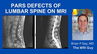 Pars defect on MRI [upl. by Eerak49]