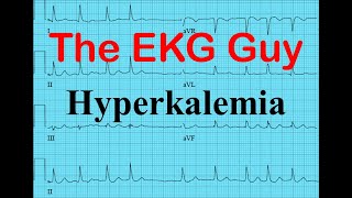 EKGECG  Hyperkalemia  The EKG Guy  wwwekgmd [upl. by Comethuauc953]