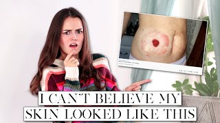 How I Healed the Skin Around My Stoma  Lets Talk IBD [upl. by Alohcin]