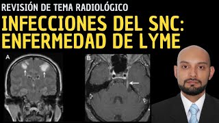 Radiología en 5 minutos Infecciones del sistema nervioso central Enfermedad de Lyme [upl. by Iniretake]