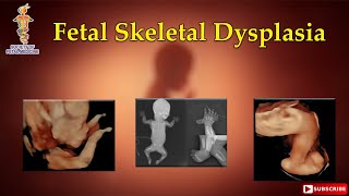 Fetal Skeletal Dysplasia [upl. by Ciapas]