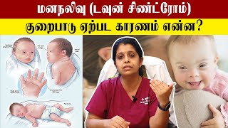 Down Syndrome Related Doubts and Treatment Tamil  Samayam Tamil [upl. by Shannan972]