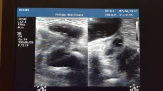 Infant Inguinal Hernia Contains Ovary  Ultrasound [upl. by Olegnaed]