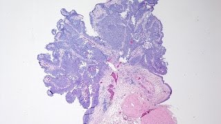 Bladder Cancer  Pathology mini tutorial [upl. by Vine]