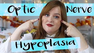 What is Optic Nerve Hypoplasia Why I’m Registered Blind  Fashioneyesta [upl. by Oiznun]