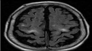 6Neuroradiology SpottersRadiology casesradiopedia [upl. by Nytsirt]