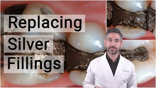 Replacing Silver Fillings with Biomimetic Dentistry  When Why and How to replace Amalgam [upl. by Perni]