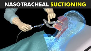 How Nasotracheal Suctioning Is Performed [upl. by Guss743]