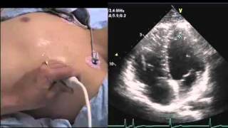 Intro to Echo Apical 4 Chamber Viewmov [upl. by Turro]