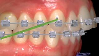 tractions intermaxillaires classe II [upl. by Gauthier]