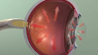 Animation Glaucoma [upl. by Schulman]