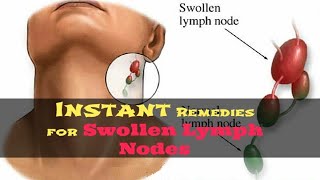 How to Get Rid of Swollen Lymph Nodes Naturally  5 Remedies for Swollen Lymph Nodes in Neck [upl. by Ferrand]