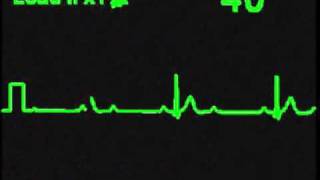 2nd Degree 21 AV Block  ECG Simulator  Arrhythmia Simulator [upl. by Ilise]