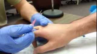 How to start an IV Dorsum of hand [upl. by Melmon]