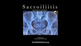 Sacroiliitis A common cause of back pain Part II [upl. by Nuahsyar]