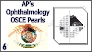 APs Ophthalmology OSCE Pearls 6 [upl. by Waldos]