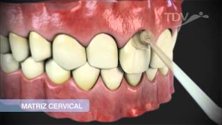 MATRIZ CERVICAL TDV  Restauraciones de Clase V [upl. by Keefer]