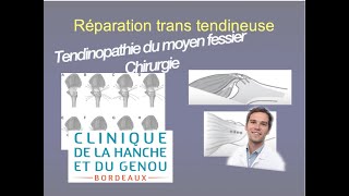 Conférence tendinoapthie du moyen fessier Partie 3 la chirurgie par le Dr Nicolas Verdier [upl. by Anyl823]