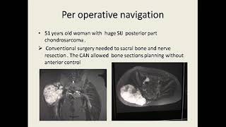 Conduite à tenir devant les tumeurs osseuses malignes articulaires [upl. by Gustavus277]