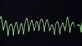 Cardiac arrest rhythms VF VT Asystole and PEA [upl. by Arika843]