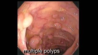 Colonoscopy FollowUp of Colon Polyp  Los Angeles Colonoscopy [upl. by Attwood162]