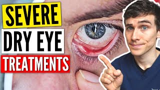 Severe Dry Eyes Treatment  Dry Eyes Treatment Guide [upl. by Aimar582]