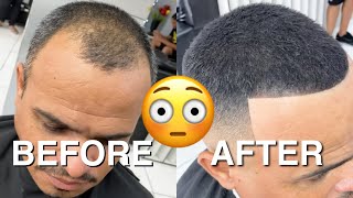 BEFORE amp AFTER From being BALD to FULL HEAD OF HAIR [upl. by Aehcim665]